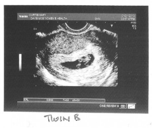 twinb_1st_photo_wb Twin B's 1st photo.