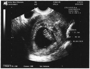 twina_2nd_photo Twin A is facing us with both arms up by the face.