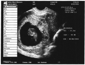 twinb_2nd_photo Twin B is turned to the side. This little one is feeling bashful, using a hand to cover the face.